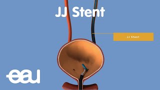 Behandlung von Nieren und Harnleitersteinen JJstent [upl. by Lopez]